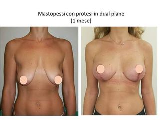 Mastopessi prima e dopo