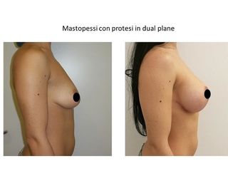 Mastopessi