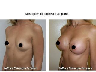 Mastoplastica prima e dopo
