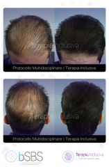 Trapianto capelli - HairClinic Bio Medical Group | Dott. Mauro Conti