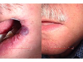Laserterapia prima dopo