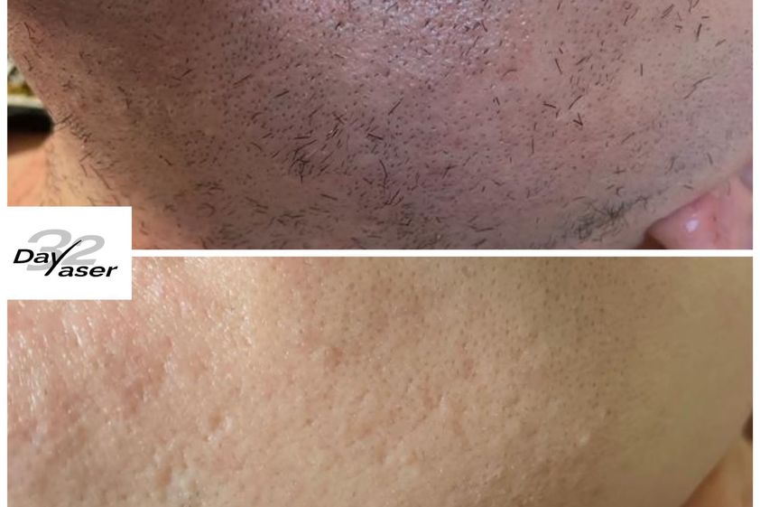 Depilazione laser prima e dopo - 857808