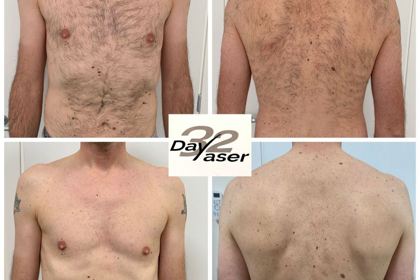 Depilazione laser prima e dopo - 857809