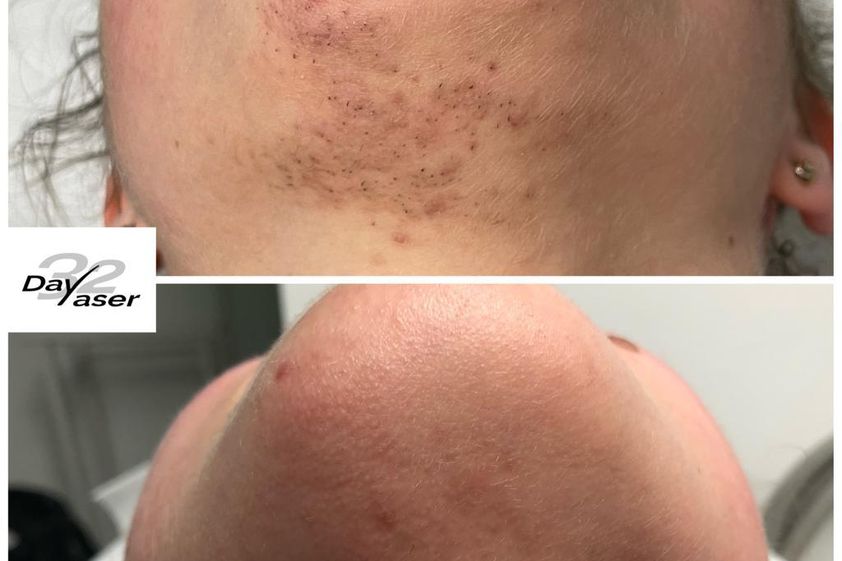 Depilazione laser prima e dopo - 857810