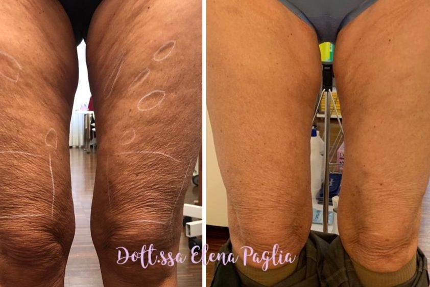 Cellulite prima e dopo - 767989