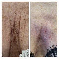 Filler - Medicina Estetica Dott. Lino Bertolini