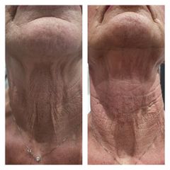 Rughe - Medicina Estetica Dott. Lino Bertolini