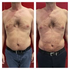Liposuzione - Medicina Estetica Dott. Lino Bertolini