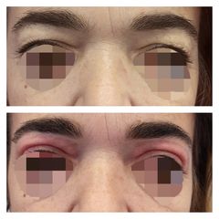Blefaroplastica non chirurgica - Medicina Estetica Dott. Lino Bertolini