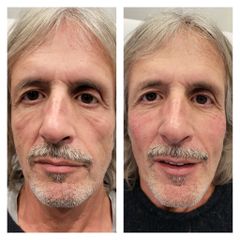 Acido ialuronico - Medicina Estetica Dott. Lino Bertolini