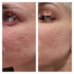 Cellulite - Medicina Estetica Dott. Lino Bertolini