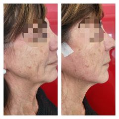 Fili riassorbibili - Medicina Estetica Dott. Lino Bertolini