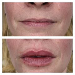 Filler labbra - Medicina Estetica Dott. Lino Bertolini