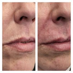 Filler - Medicina Estetica Dott. Lino Bertolini