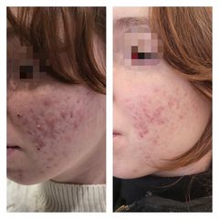 Acne - Medicina Estetica Dott. Lino Bertolini