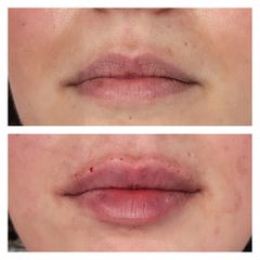 Filler labbra - Medicina Estetica Dott. Lino Bertolini
