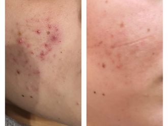 Acne prima e dopo - 866565