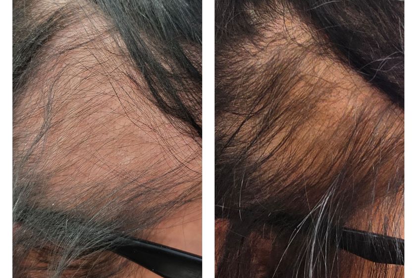 Alopecia prima e dopo - 869228