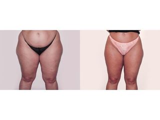 Liposuzione prima e dopo