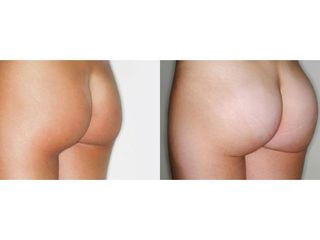 Gluteoplastica prima e dopo