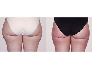 Liposuzione prima e dopo