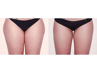 Liposuzione prima e dopo