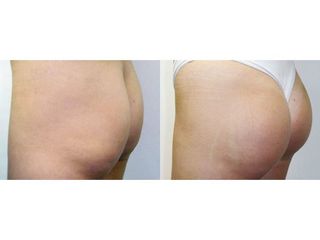Gluteoplastica prima e dopo