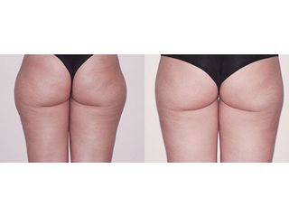 Liposuzione prima e dopo