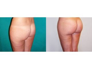Gluteoplastica prima e dopo