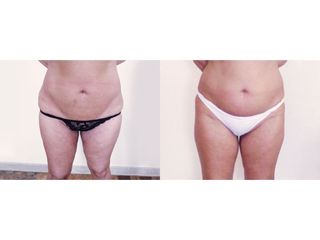 Liposuzione prima e dopo