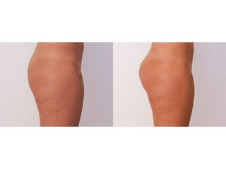 Gluteoplastica prima e dopo