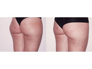 Liposuzione prima e dopo