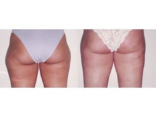 Liposuzione prima e dopo