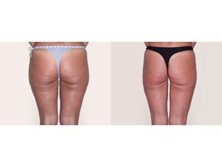Liposuzione prima e dopo