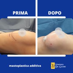 Mastoplastica additiva - Prof. Vincenzo Del Gaudio