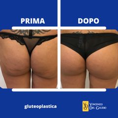 Gluteoplastica - Prof. Vincenzo Del Gaudio