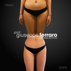 Liposuzione - Prof. Giuseppe A. Ferraro