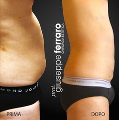 Addominoplastica - Prof. Giuseppe A. Ferraro