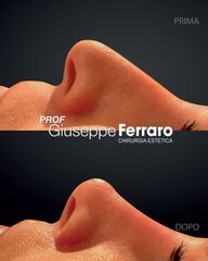 Rinoplastica - Prof. Giuseppe A. Ferraro