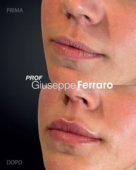 Filler labbra - Prof. Giuseppe A. Ferraro