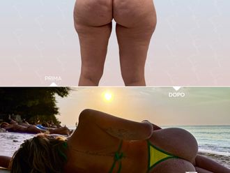Liposuzione prima e dopo - 878494