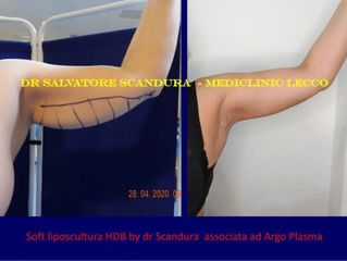 Liposuzione braccia - Dott. Salvatore Scandura