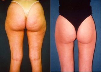 liposuzione prima dopo