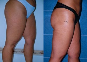 liposuzione prima dopo