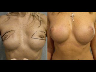 Lipofilling - Dott. Marcello Melandri