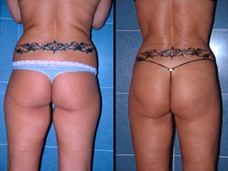 Liposuzione - Dott. Marcello Melandri