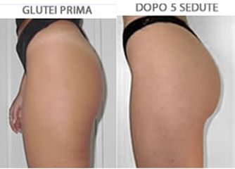 Gluteoplastica prima e dopo