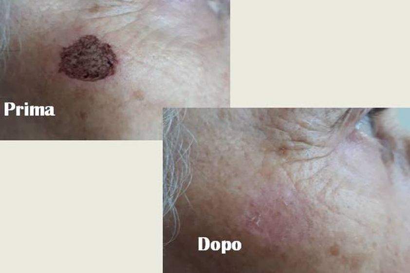 Macchie della pelle prima e dopo - 764740