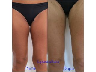Liposcultura prima e dopo