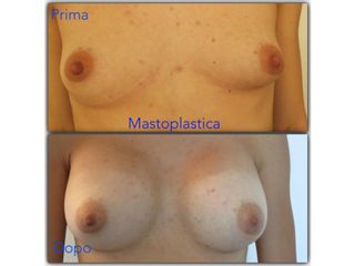 mastoplastica additiva
